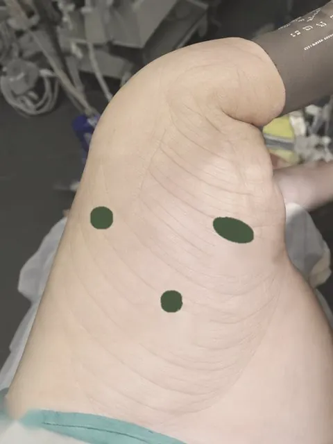 Tórax de paciente em posição lateral com as três pequenas incisões da videotoracoscopia marcadas